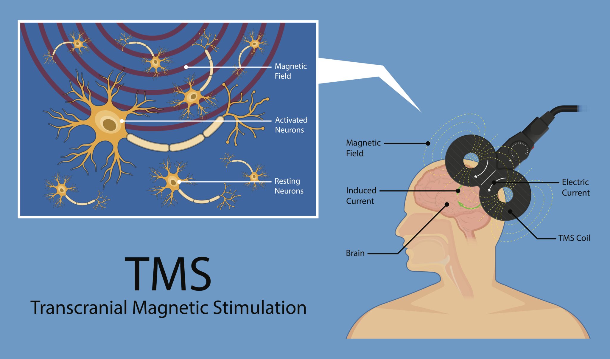 TMS: hope in the treatment of resistant depression - drmarcellestastny